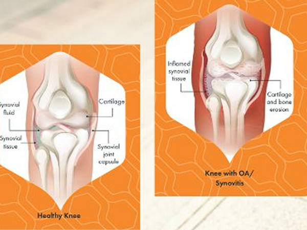 Arthrosamid Knee Joint Graphics800